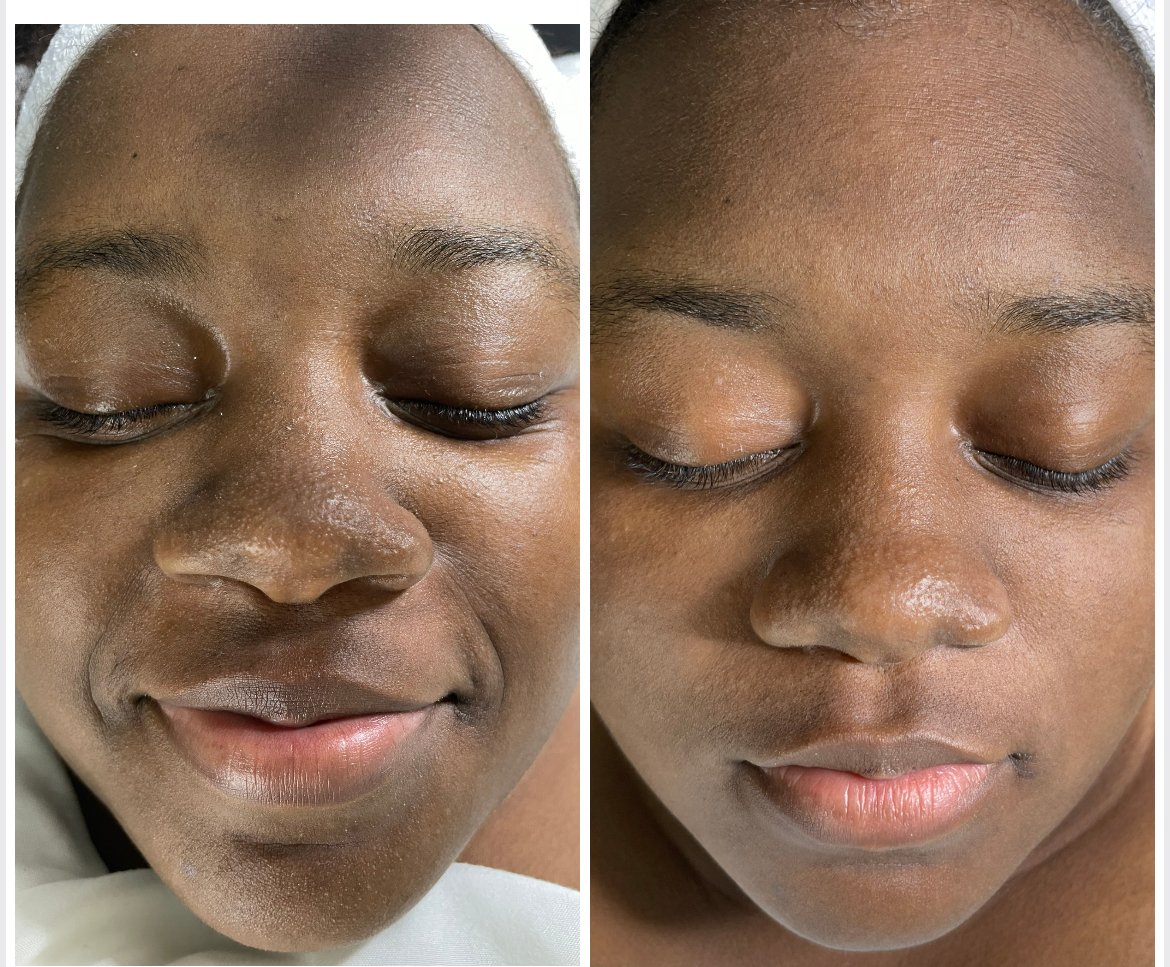 Facial profundo