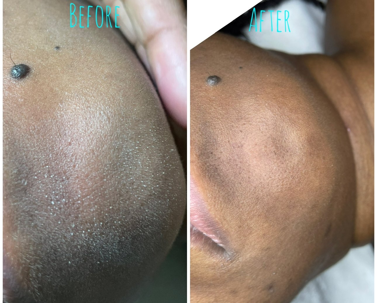 Microdermoabrasión facial