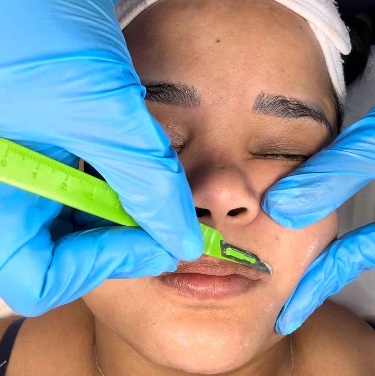 Dermaplaning