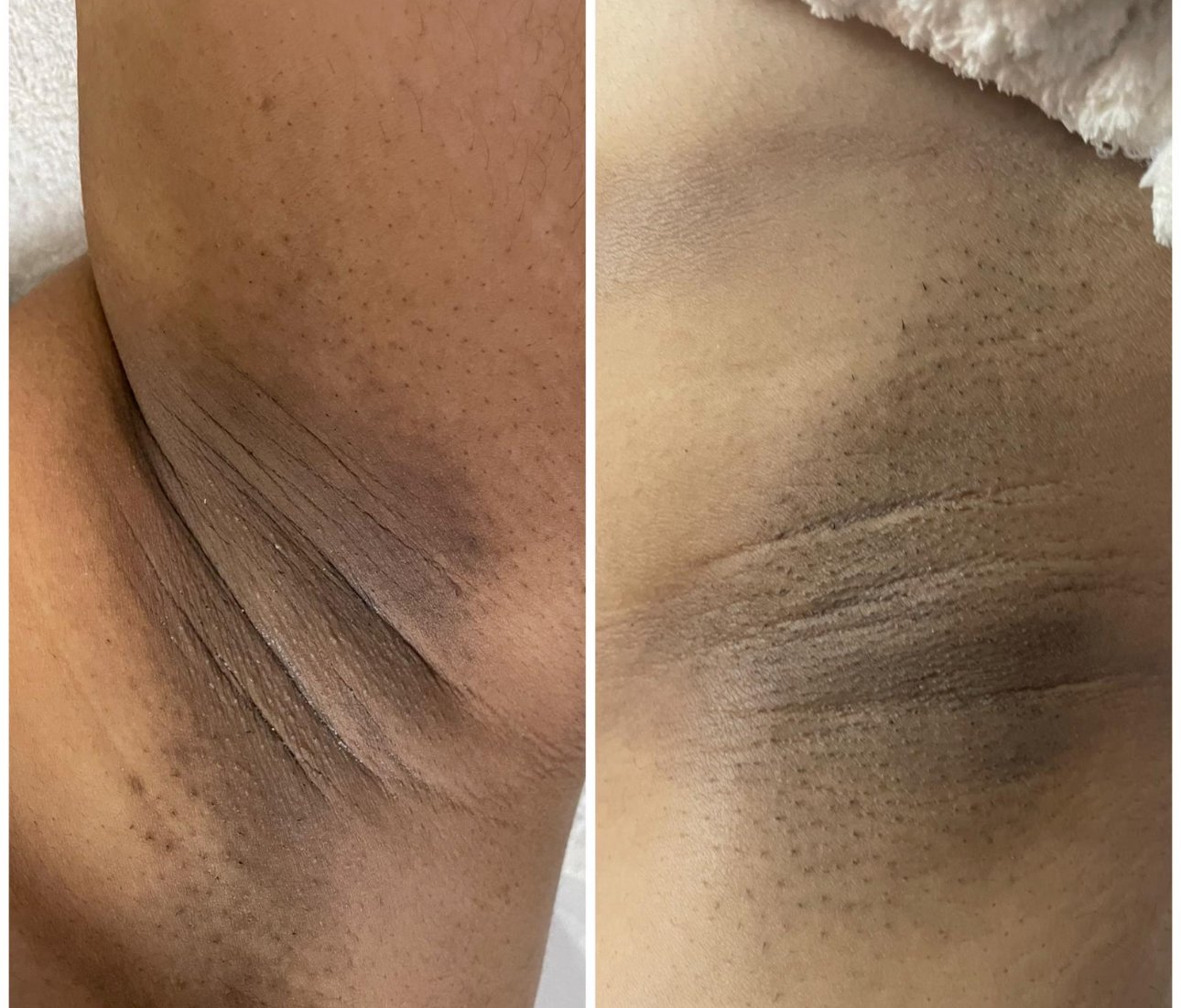Pigmentación de zonas oscuras (bikini y axilas)