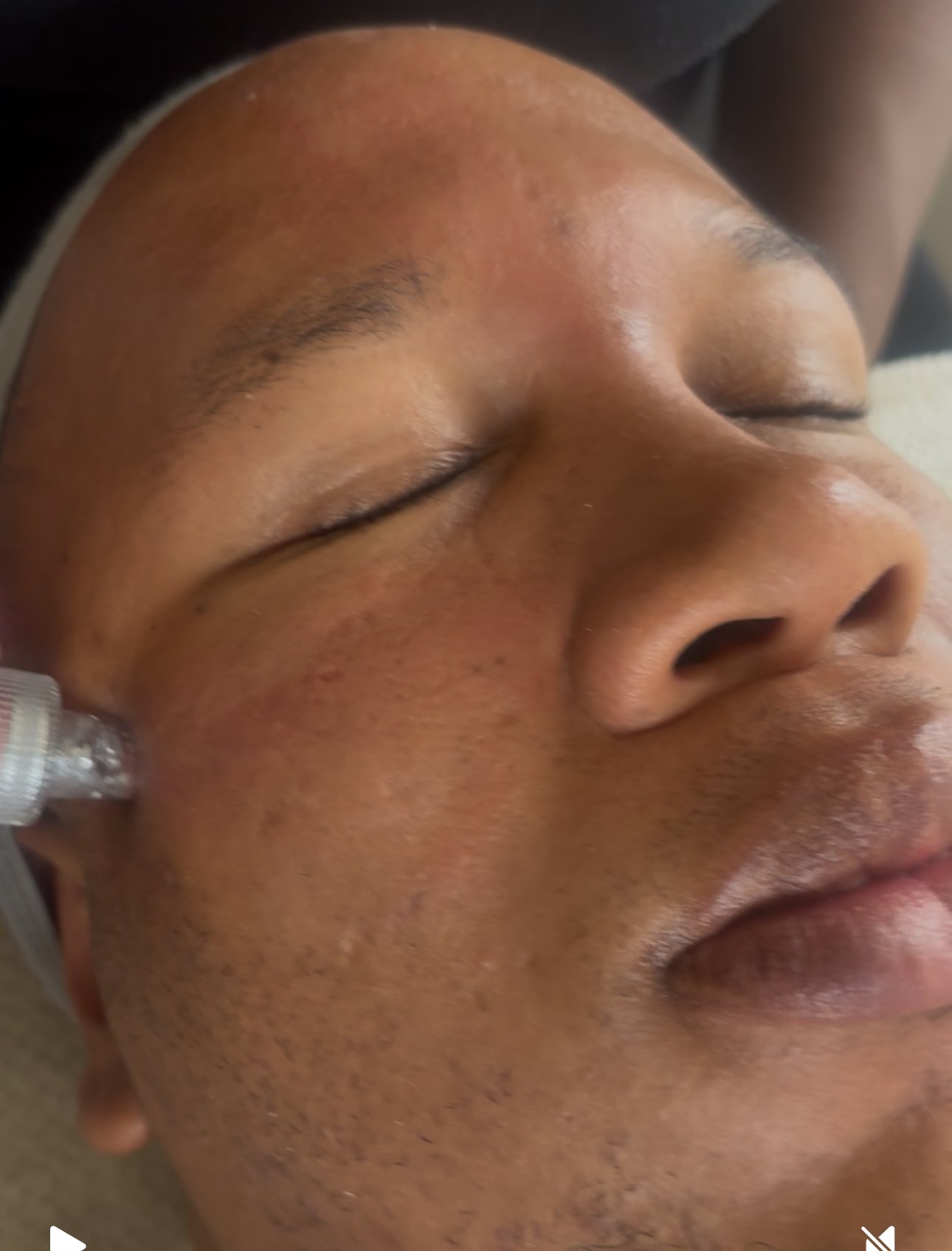 Hydrafacial