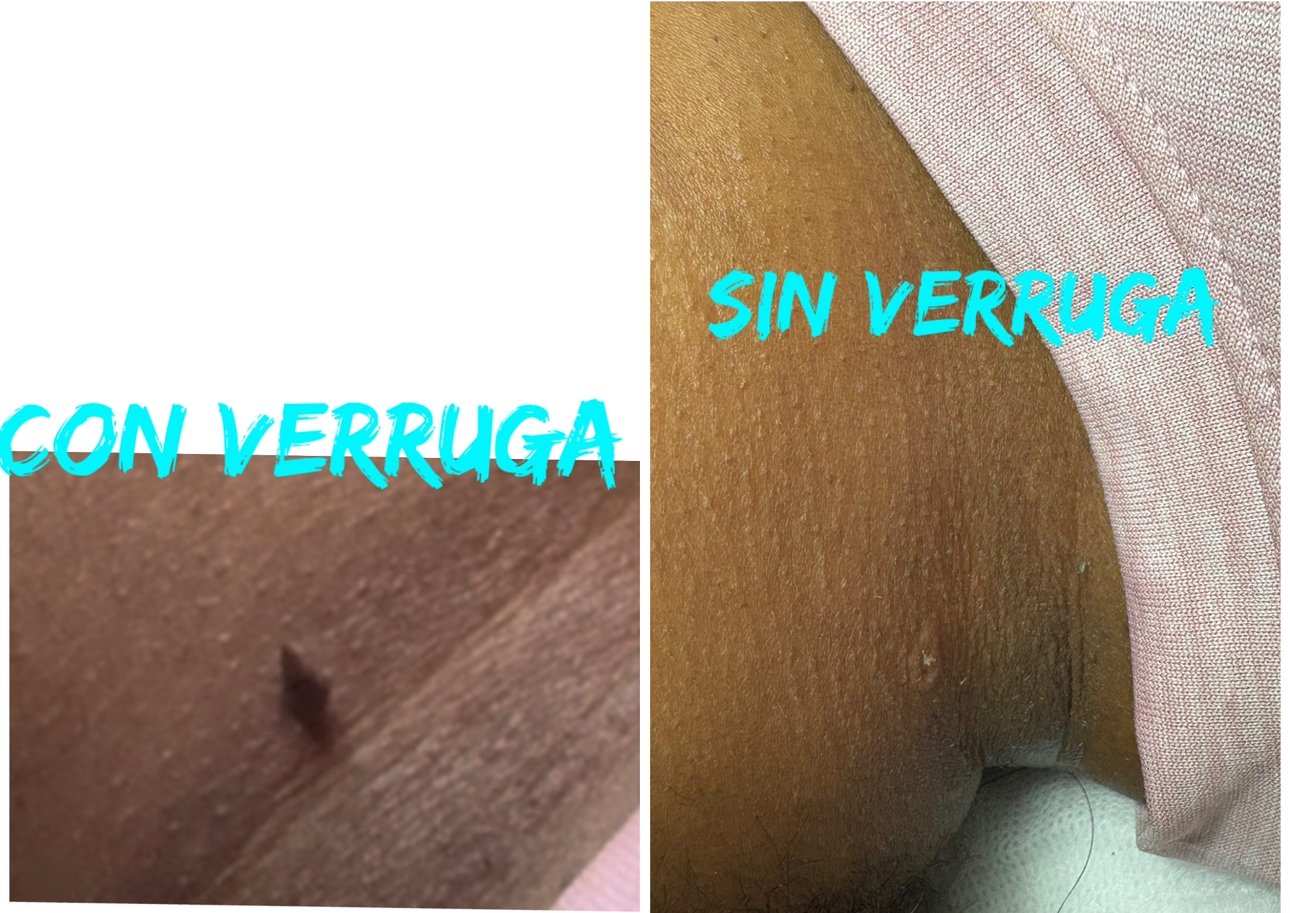 Eliminación de verrugas
