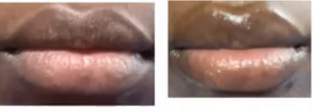 Tratamiento de labios